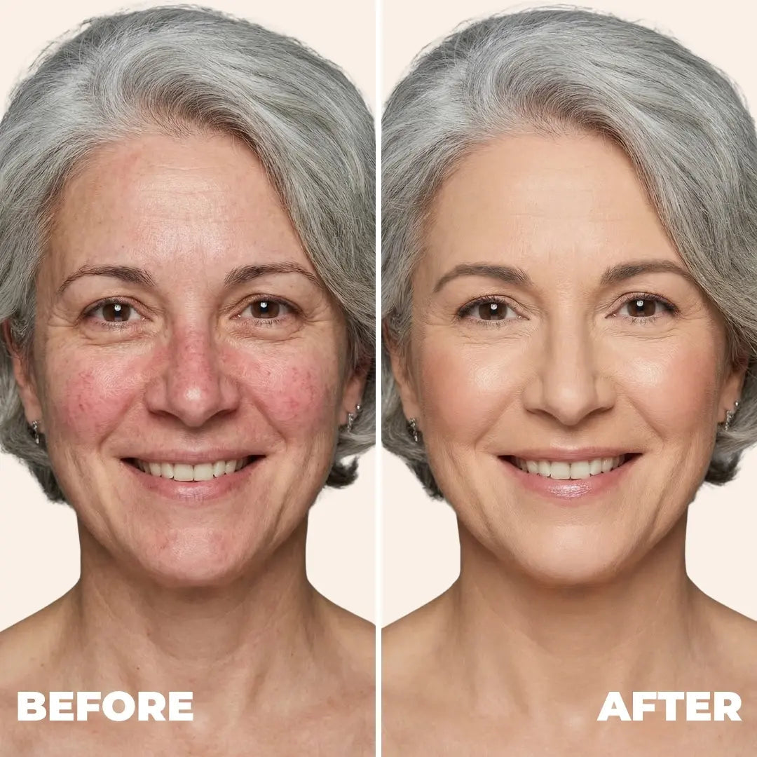 Melya™ Changing Foundation For Rosacea