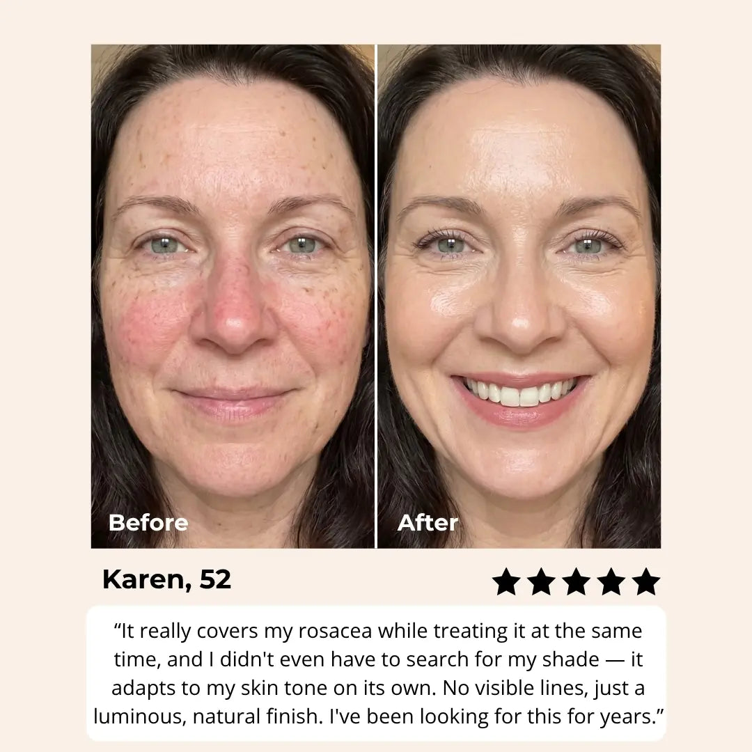 Melya™ Changing Foundation For Rosacea
